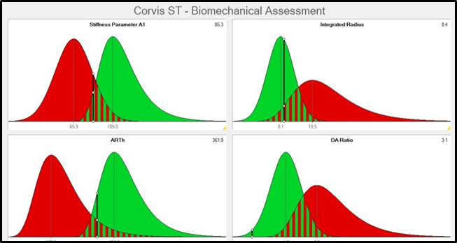 Four biomechanical parameters and the relation to normative data of healthy patients (green) and keratoconic patients (red) in 2014 (top) and 2018 (bottom) of right and left eye.