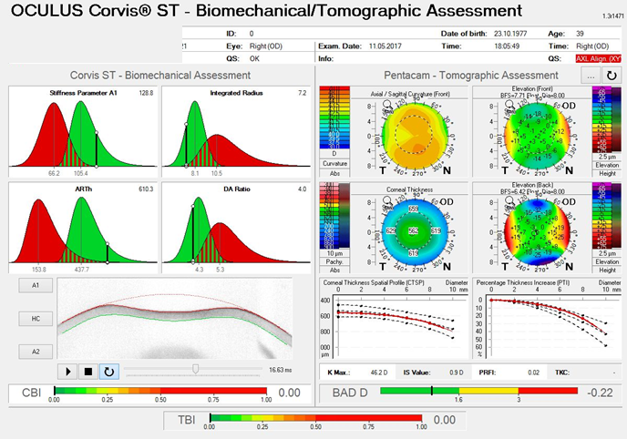 OD: Ambrósio, Roberts & Vinciguerra Tomography and Biomechanics Report (ARV Report) for both eyes.