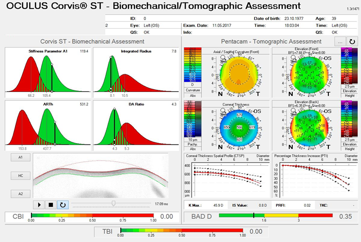 OS: Ambrósio, Roberts & Vinciguerra Tomography and Biomechanics Report (ARV Report) for both eyes.