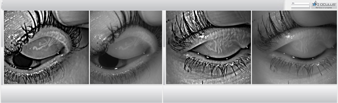 Meibomian glands photopraphy by slit lamp imaging and Placido-topography imaging.